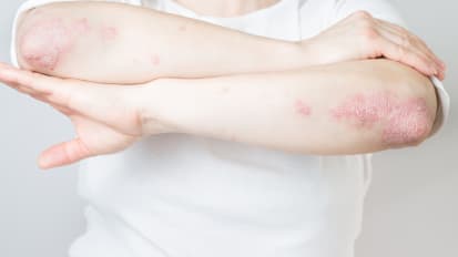 Latest and Greatest in Acne, Eczema, and Warts