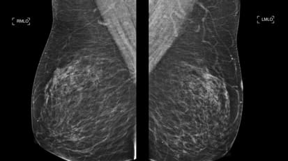 Contrast-Enhanced Mammography