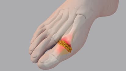 More Than a "Nuisance Arthritis": Gout's Effects on the Cardiovascular System