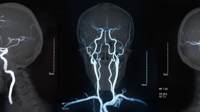 Update on the Management of Intracerebral Aneurysms