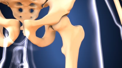 The Hypermobile Hip: Biomechanics, Diagnosis, and Treatment Decision Making: Part 2
