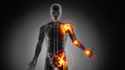 Introduction to Rare/Genetic Rheumatic Diseases 