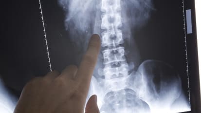 The XLIF Procedure: A Minimally Disruptive Surgical Treatment for Degenerative Spine Conditions