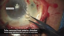 Surgical Revision of an Exposed Baerveldt Tube Shunt Associated with Scleral Melt
