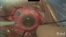 Visualization for Vitrectomy, Video 2