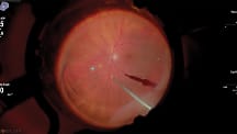 2026 Surgical Roundtable Case 1: Managing Giant Retinal Tears 