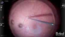 Visualization for Vitrectomy, video 1