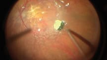 Surgical Roundtable Case 4: Implanting a Subretinal Photovoltaic Prosthesis