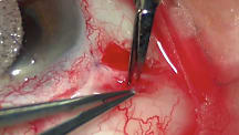 Tenon's Window in Xen Gel Stent Revision