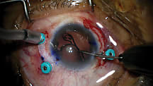2026 Surgical Roundtable Case 2: Managing a Dislocated Scleral-Fixated IOL