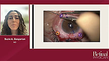 Management of Complex Dislocated In-the-Bag Intraocular Lenses