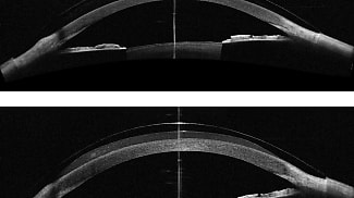 CL Leaders Present Insights on the Modern Era of Scleral Lenses