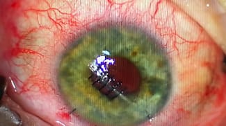 Mastering Comanagement With Corneal Specialists