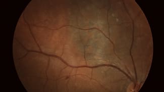 Eight red flags for a choroidal melanoma
