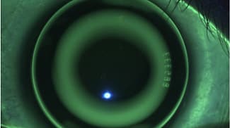 Providing protocols for myopia control using contact lenses 