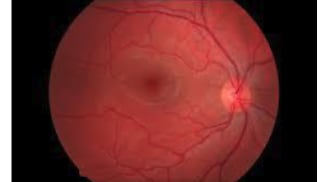 Beyond Amblyopia