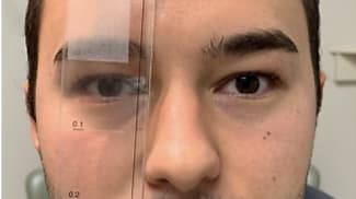 Patient candidacy for diplopia interventions revealed