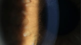 Monitoring for ocular toxicity in cancer patients