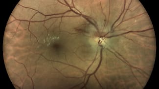 Patient Complaints Linked With Optic Neuropathies 