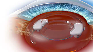 Data on IOL-based Delivery of Bimatoprost Presented at ASCRS