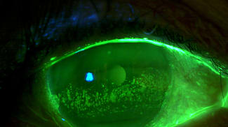 Rethinking Dry Eye Symptoms