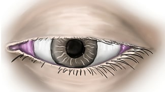 Five Red Flags for Asymmetric Lid Ptosis