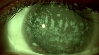Facilitating dry eye disease management