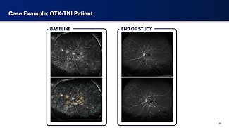 OTX-TKI May Decrease Retinal Leakage in NPDR