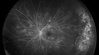 Interim Phase 1 HELIOS Trial Data of Axpaxli for NPDR Presented at ASRS