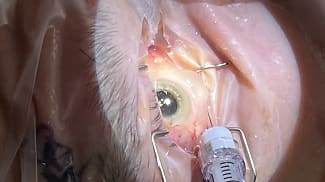 Transitioning to Dropless Cataract Surgery
