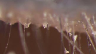 Demodex: Another Means of Preventing Contact Lens Dropout?