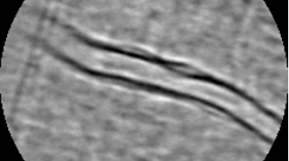 Imaging Leukocyte Dynamics in Retinal Disease