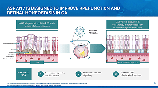 Stem Cell Therapy Shows Early Vision Gains in GA