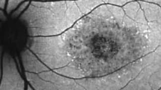 TEASE-3 Study Data on Oral Therapy for Stargardt Disease Presented at ASRS