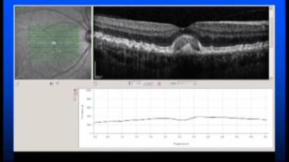 Mayo Clinic Ophthalmology Retina Update and Case Conference: Wet AMD or Not