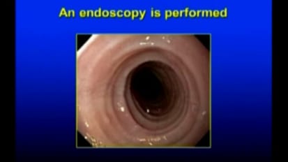 Grand Rounds en Español: La Nueva Epidemía Esofágica del Siglo XXI