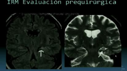 Grand Rounds en Español: Epilepsia en la Clínica