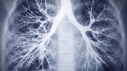 Clinical Minutes: Lung Cancer Screening