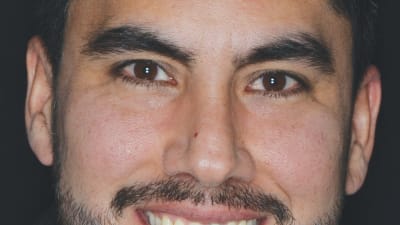 Leveraging Digital Smile Design Technology in Esthetic Restorative Dentistry