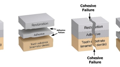 When Restorations Fail: A Step-by-Step Guide to Adhesive Repair