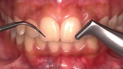 Effective Yet Gentle: Preservation of Dental Restorations During Periodontal Debridement