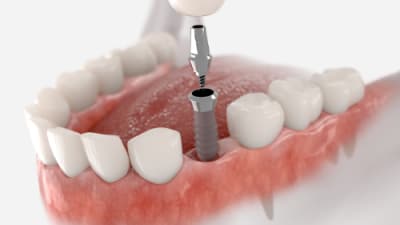 Breakthroughs in Dental Implantology | Compendium