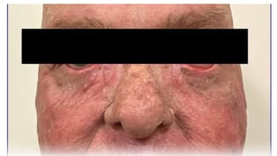 Concurrent Ocular and Dermatologic Toxicities Associated With Docetaxel Chemotherapy