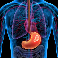 Episode 59: Opening Doors to Treatment: Therapies for Gastrointestinal Stromal Tumors