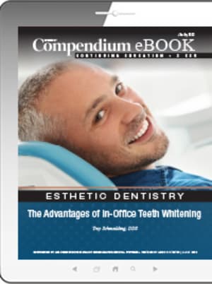 The Advantages of In-Office Teeth Whitening