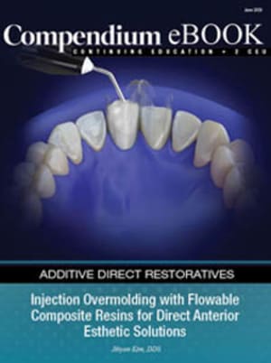 Injection Overmolding With Flowable Composite Resins for Direct Anterior Esthetic Solutions 