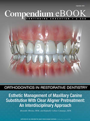 Esthetic Management of Maxillary Canine Substitution With Clear Aligner Pre-Treatment: An Interdisciplinary Approach