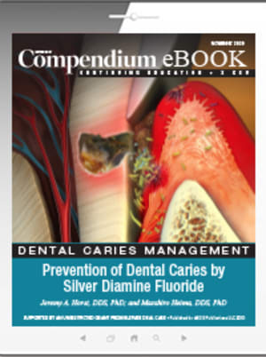 Prevention of Dental Caries by Silver Diamine Fluoride