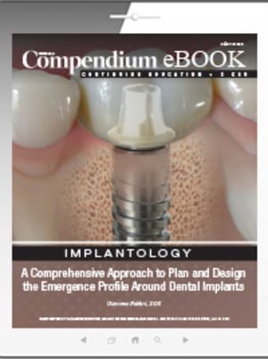 A Comprehensive Approach to Plan and Design the Emergence Profile Around Dental Implants