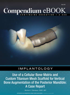 Use of a Cellular Bone Matrix and Custom Titanium Mesh Scaffold for Vertical Bone Augmentation of the Posterior Mandible A Case Report